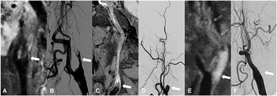 High-resolution magnetic resonance imaging for predicting successful recanalization in patients with chronic internal carotid artery occlusion